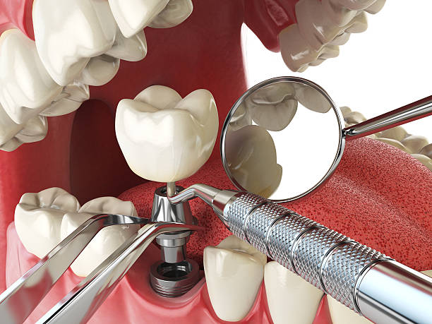 Best Emergency Dental Extractions in Columbia, MO